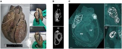 A Novel Idiopathic Atrial Calcification: Pathologic Manifestations and Potential Mechanism